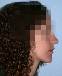 implantes dentales